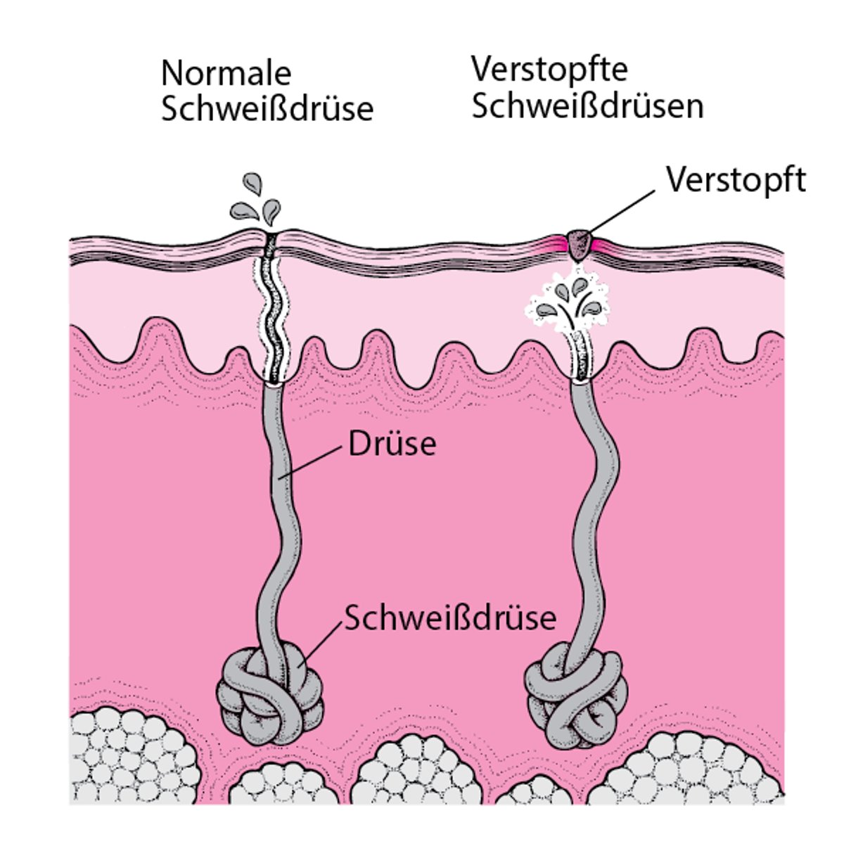 Was verursacht Schweißflechte?