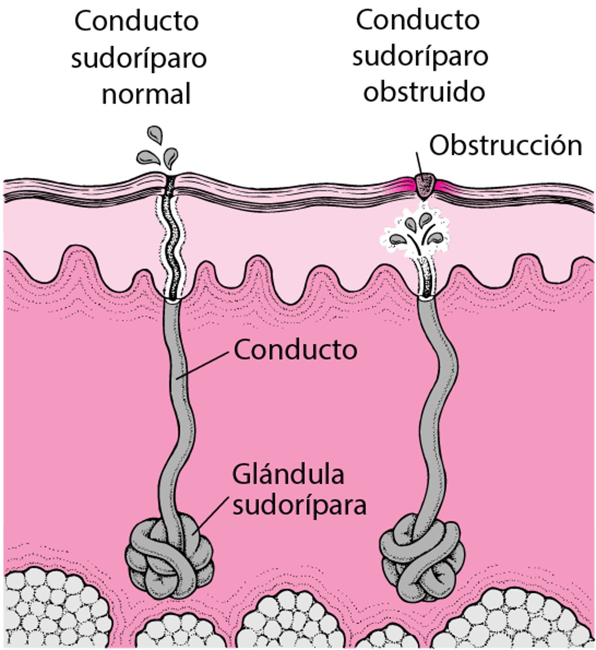 ¿Qué causa la sudamina?