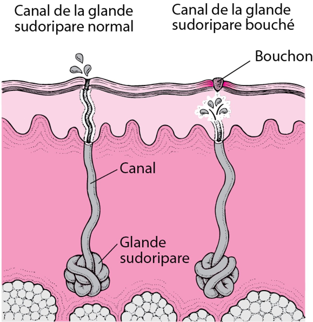 Quelle est la cause de la miliaire ?
