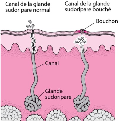 Quelle est la cause de la miliaire ?