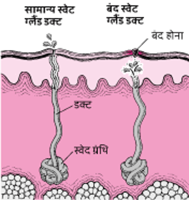 घमौरियां क्यों होती हैं?