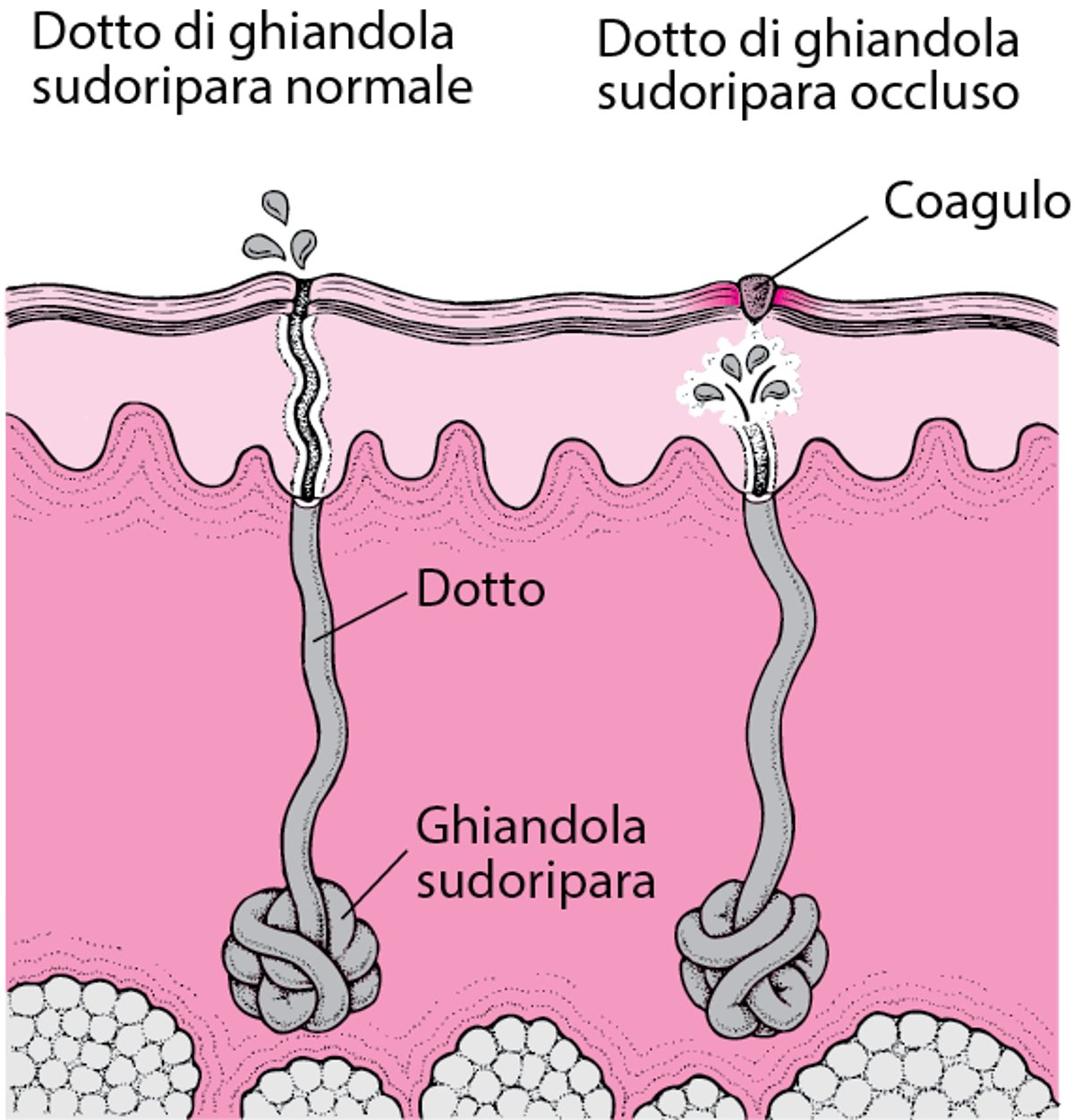 Quale è la causa della sudamina?