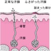 あせもの原因
