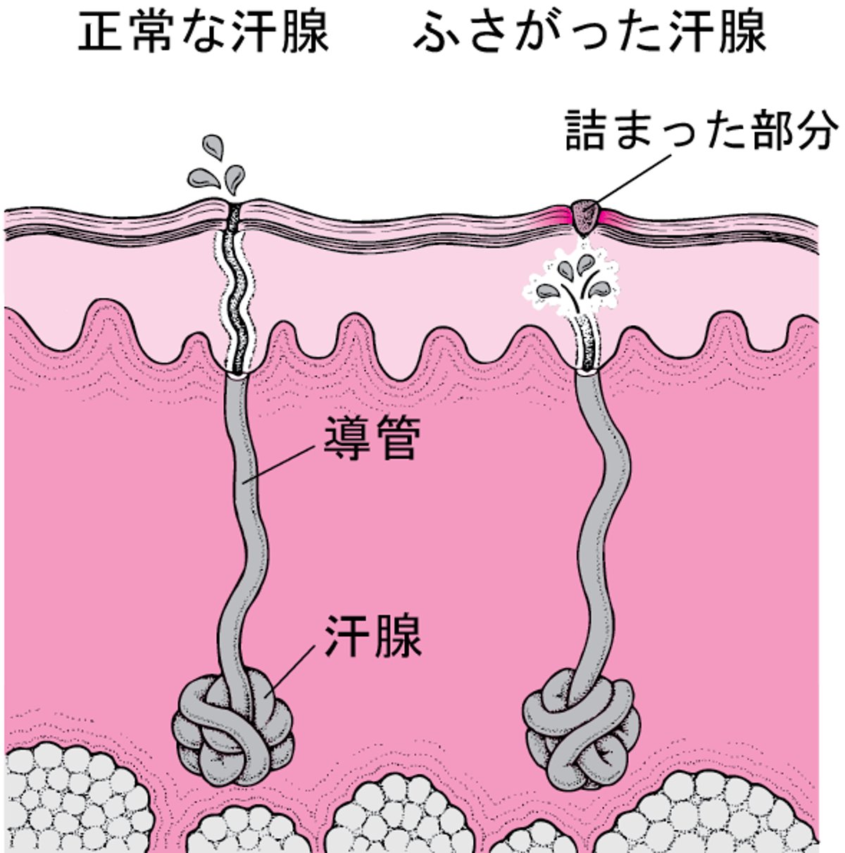あせもの原因