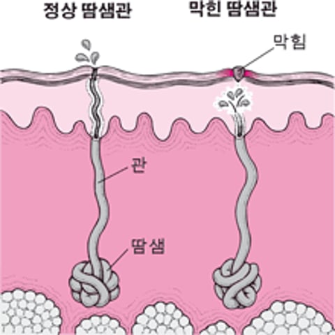 땀띠의 원인은 무엇입니까?