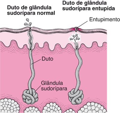 O que causa a brotoeja?
