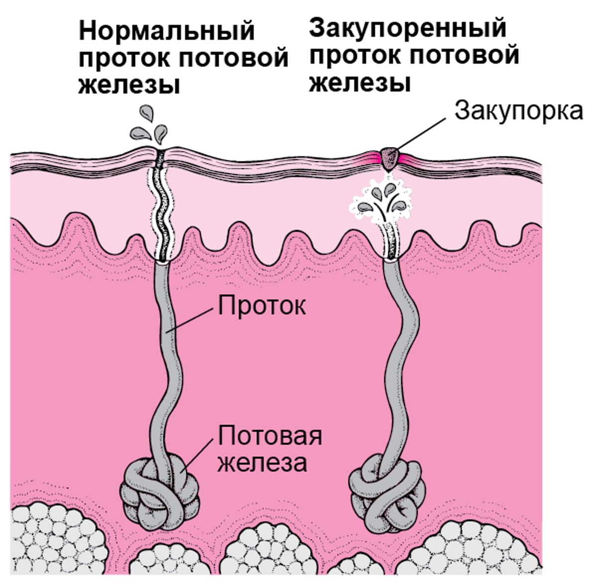 Что вызывает потницу?