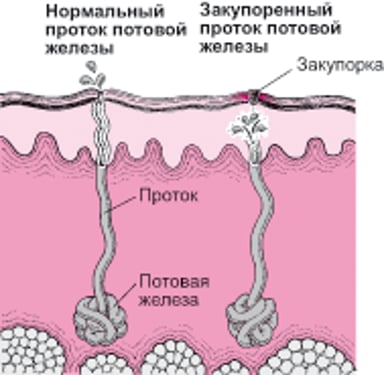 Что вызывает потницу?