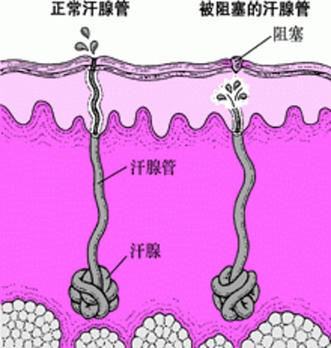 痱子是怎么产生的？