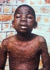 Smallpox Rash