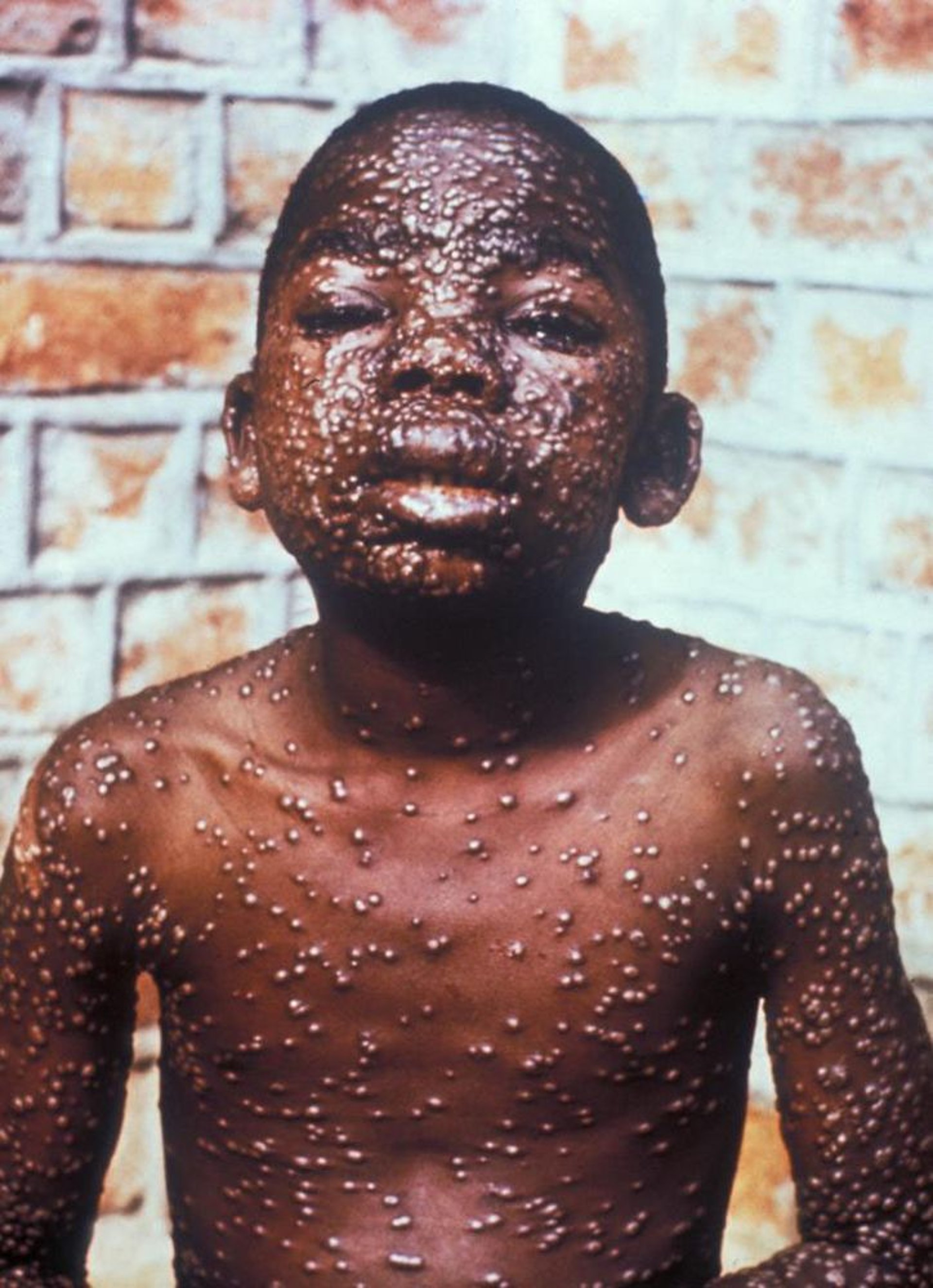 天然痘の発疹