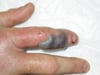 Snakebite Wound