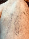 脚のくも状血管腫