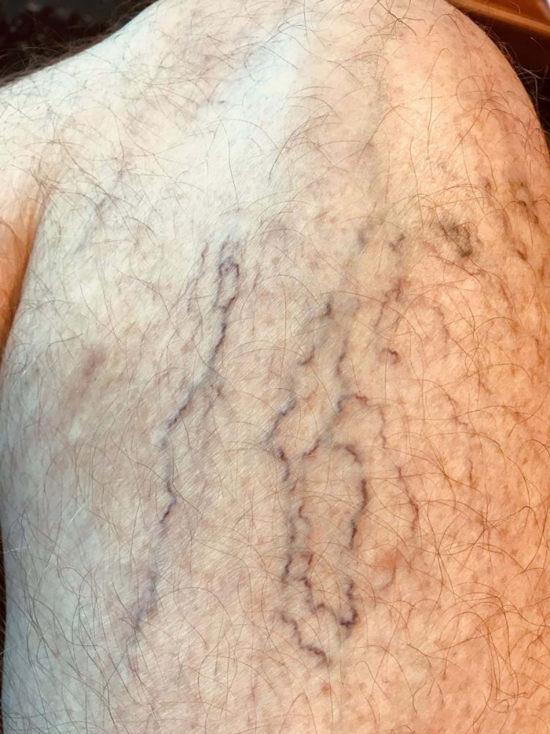 腿部蜘蛛静脉