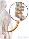 Espondilolistesis