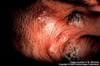 Sporotrichosis: Nodules