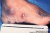 Sporotrichosis