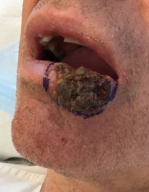 Carcinoma de células escamosas (lábio)