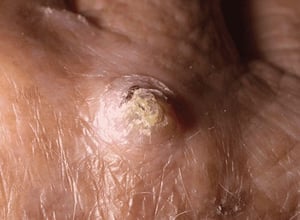 Carcinoma espinocelular