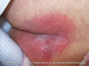 Úlcera de decúbito em estágio I (nádegas)