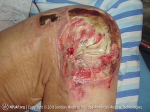 Úlcera de decúbito em estágio IV (joelho)