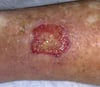 Stasis Dermatitis (Open Sore)