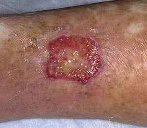Dermatite de stase (plaie ouverte)