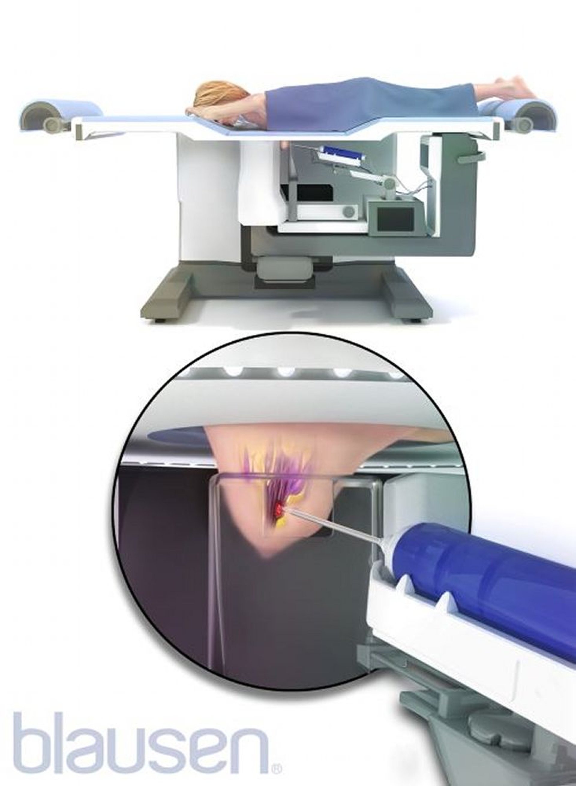 Stereotactic Breast Biopsy