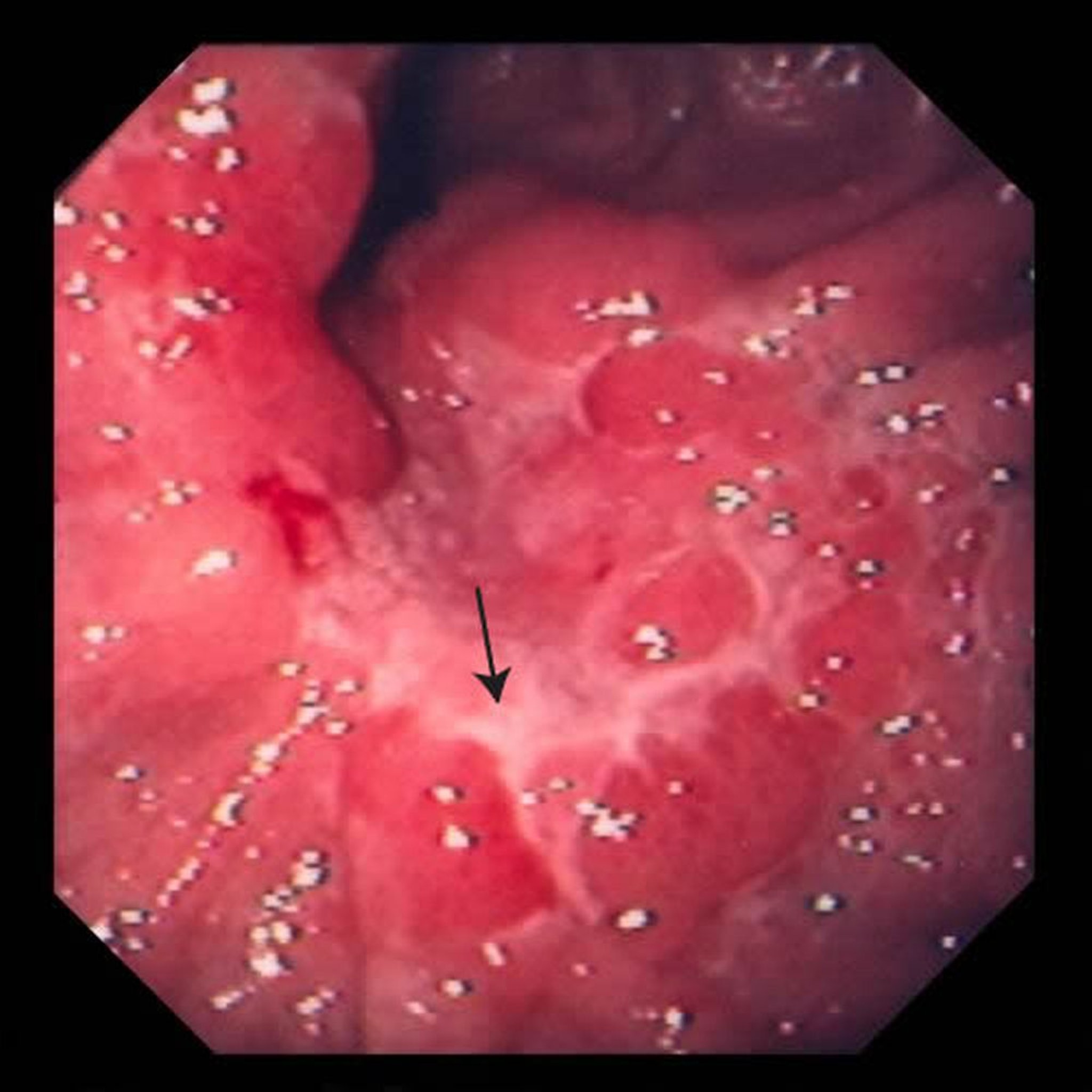 Cáncer de estómago