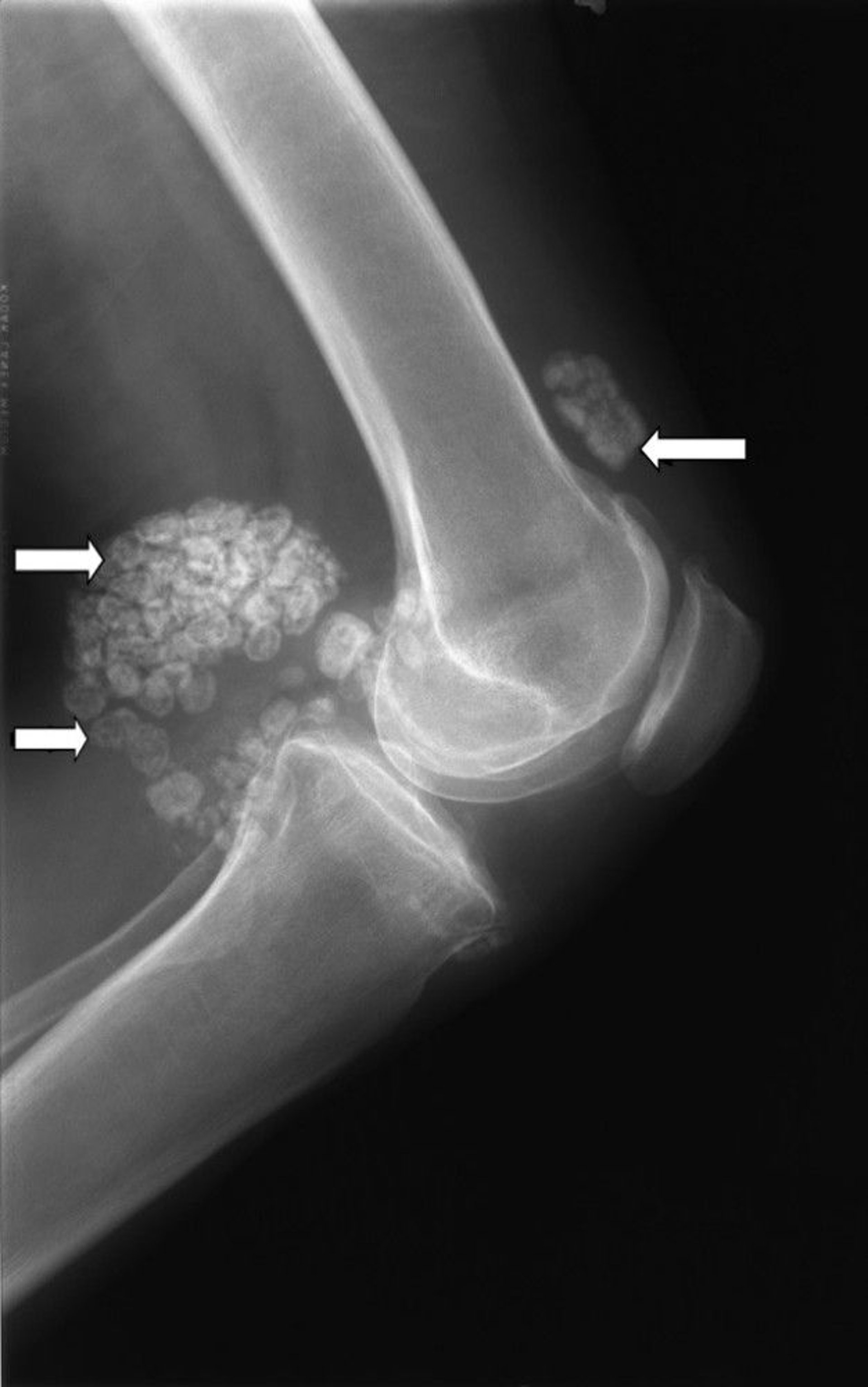 Synovial Chondromatosis