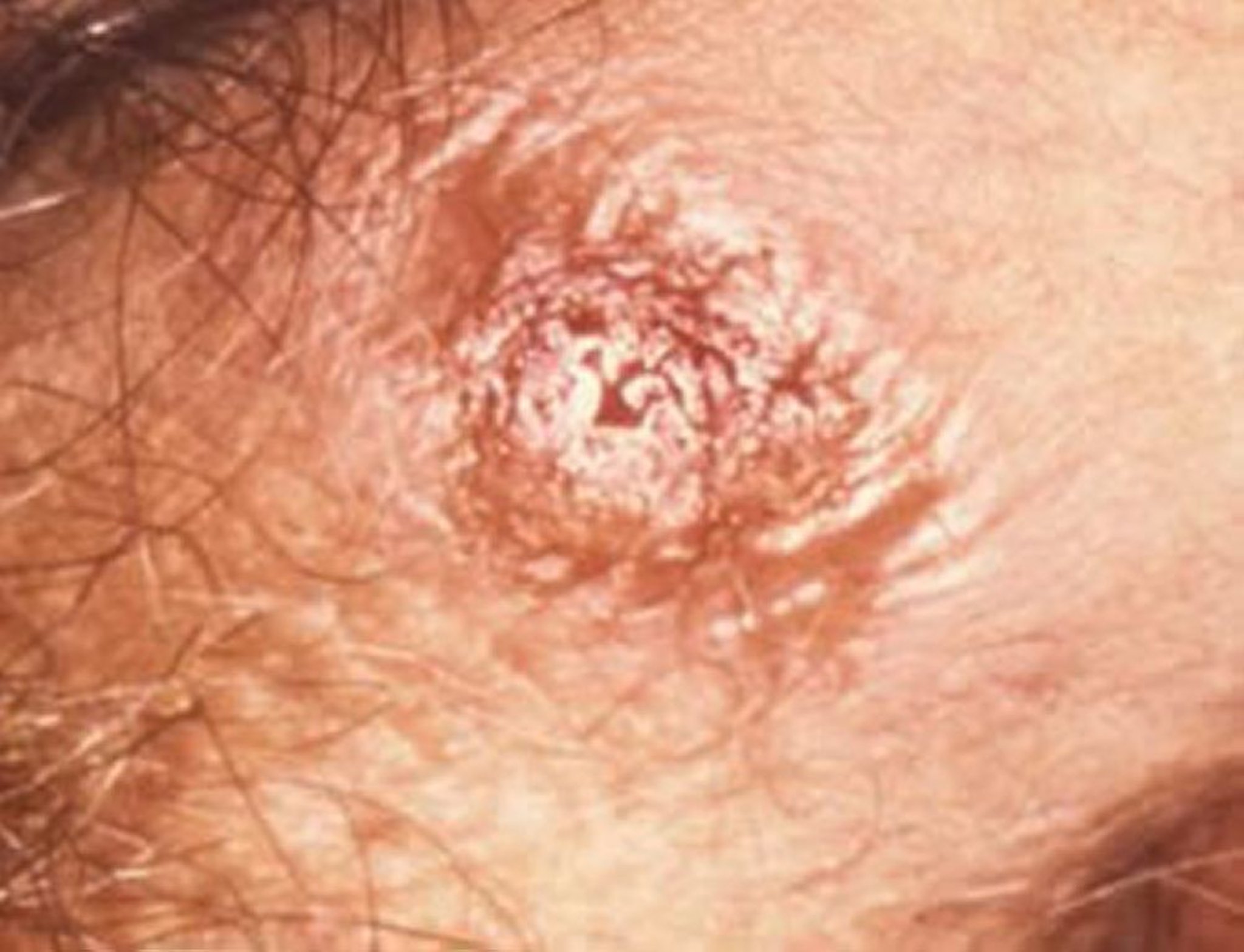 Syphilis – Phase primaire : chancre sur les organes génitaux