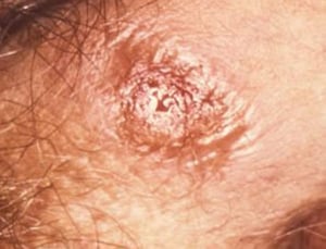 Syphilis primária: cancro nos genitais