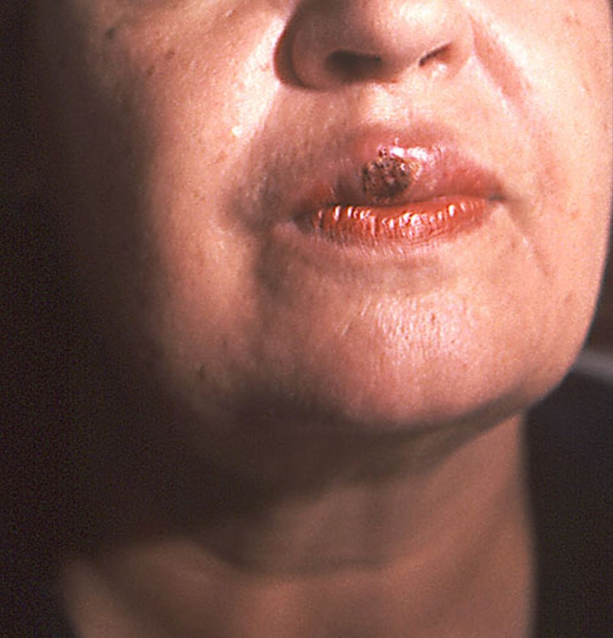 Sífilis primaria (chancro de la boca)