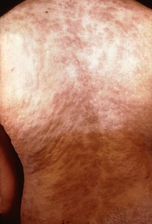 梅毒—第2期：背中の発疹
