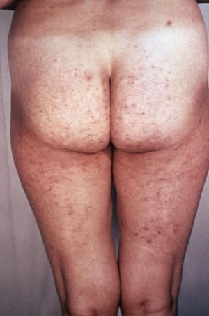 Syphilis – phase secondaire : Éruption cutanée