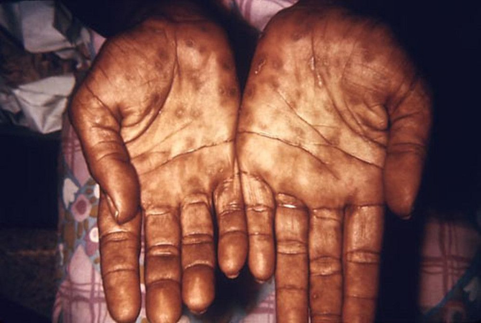 Image:Secondary Syphilis: Rash on the Palms-Merck Manual Consumer Version