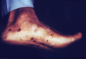 Syphilis – phase secondaire : éruption cutanée sur la plante des pieds