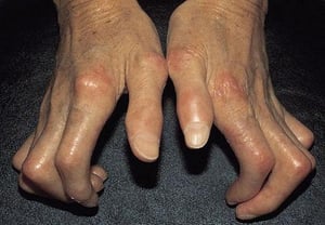 Systemic Sclerosis of the Hands