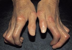 Systemische Sklerodermie der Hände