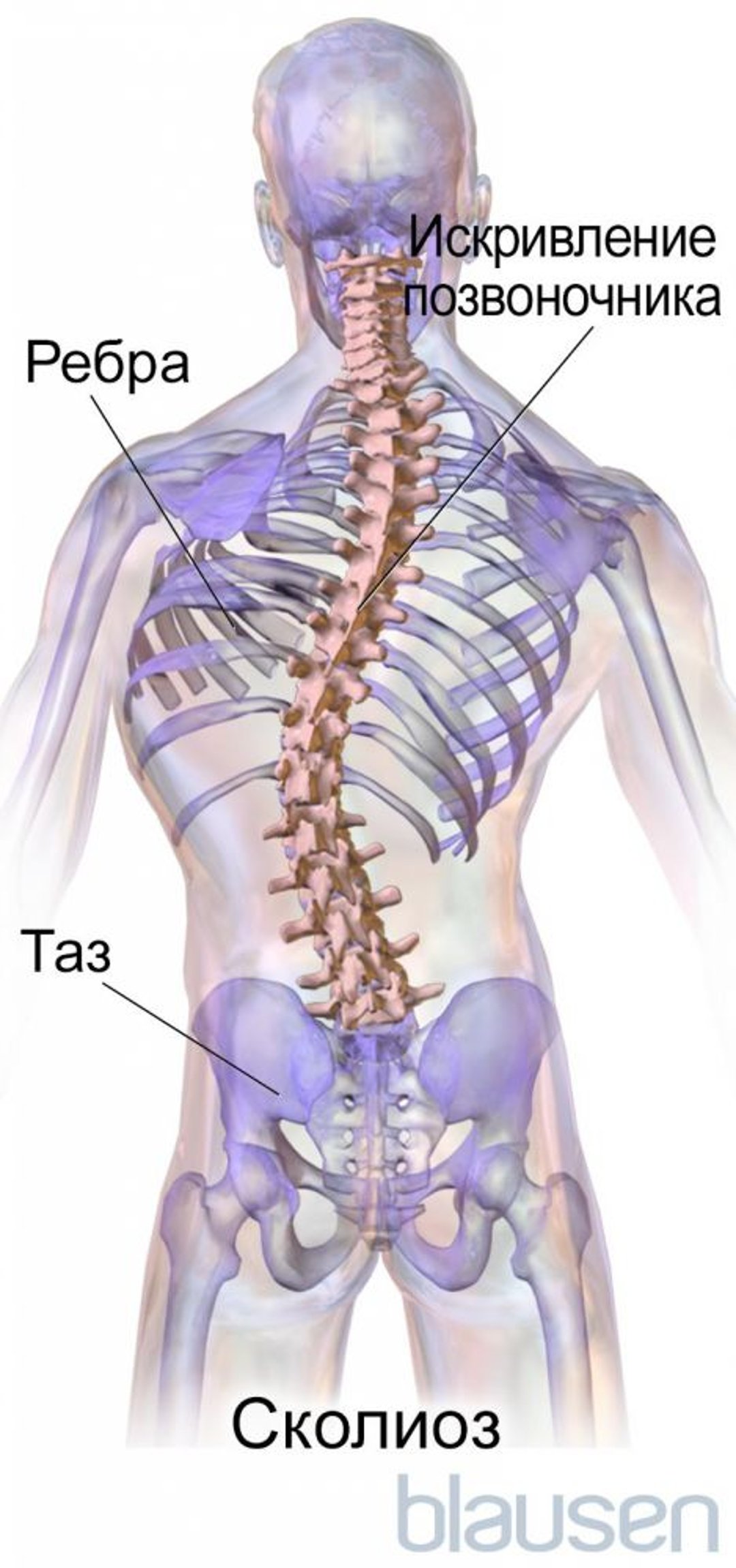 сколиоз.
