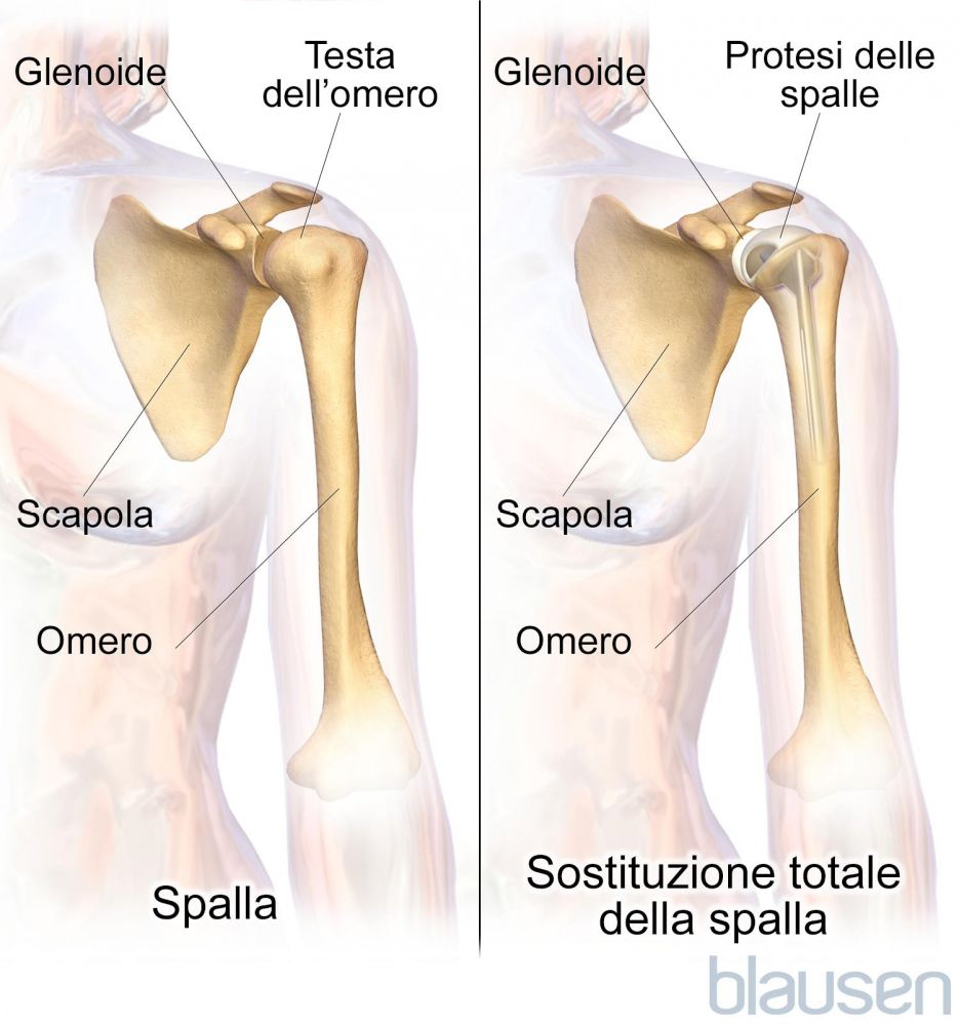 Plastica totale (artroplastica) della spalla