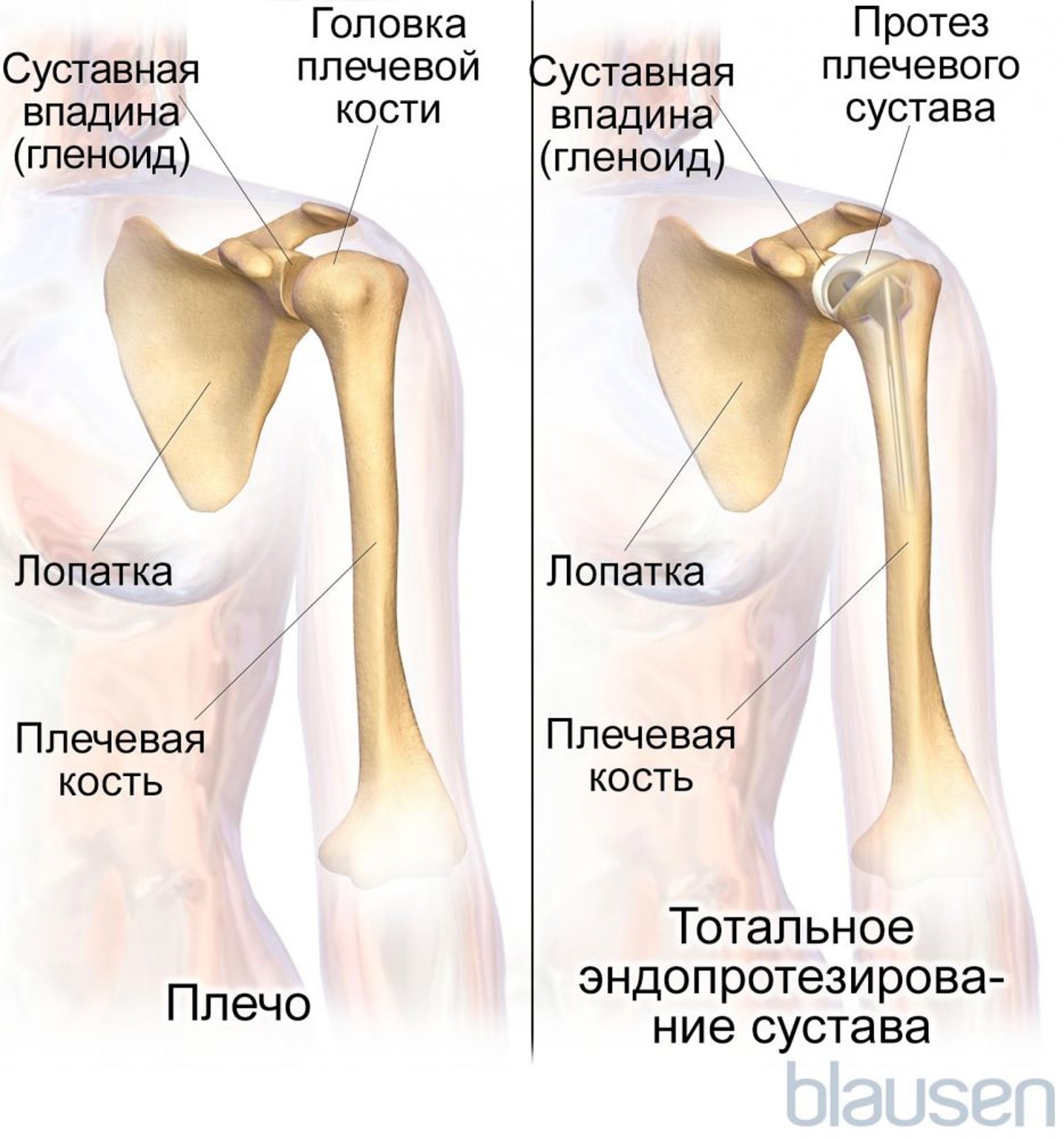Тотальное эндопротезирование плечевого сустава (артропластика)