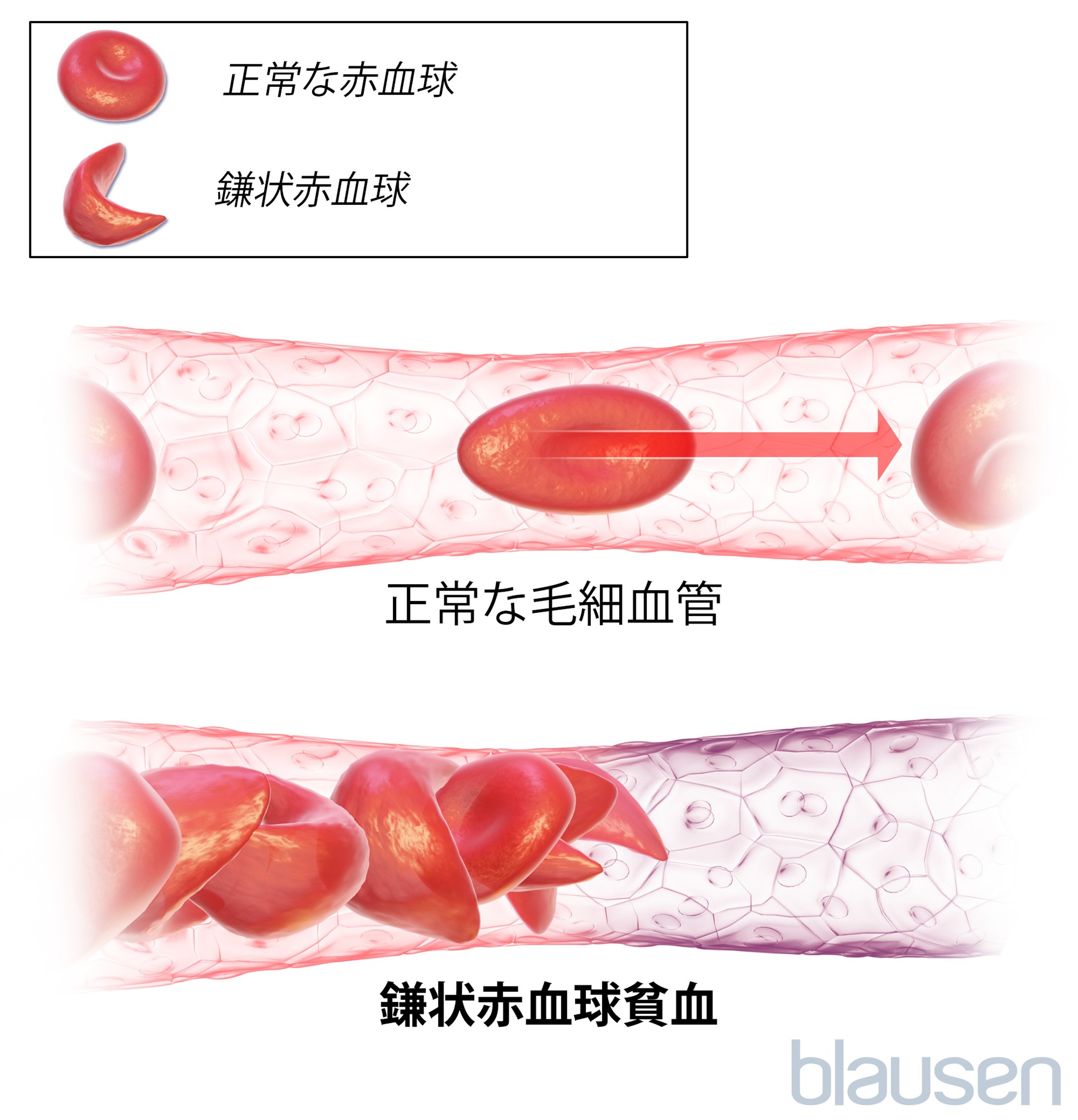<ruby >鎌状赤血球症<rt >かまじょうせっけっきゅうしょう</rt></ruby>