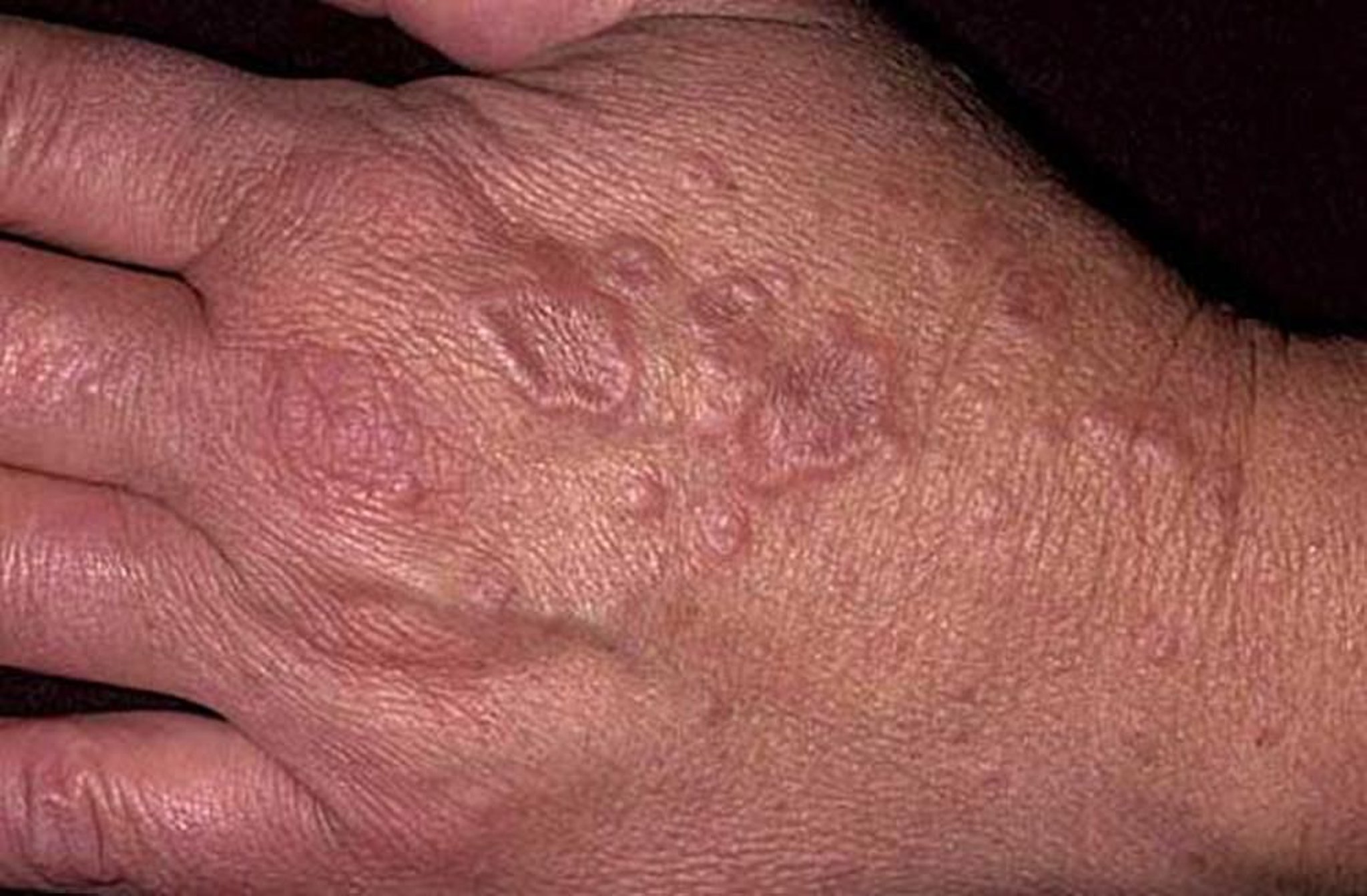 Granuloma anulare