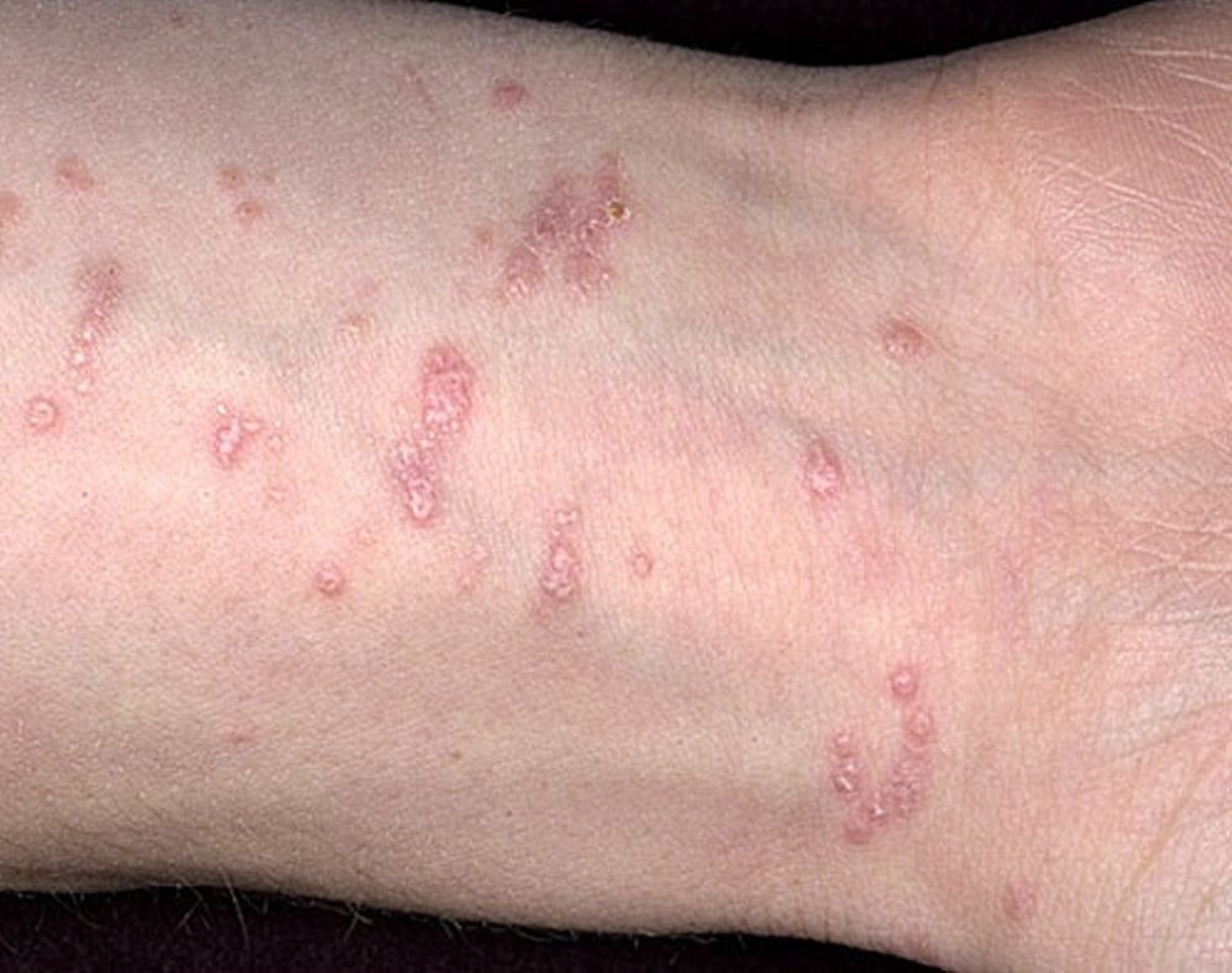 Uvimbe mdogo kwenye ngozi