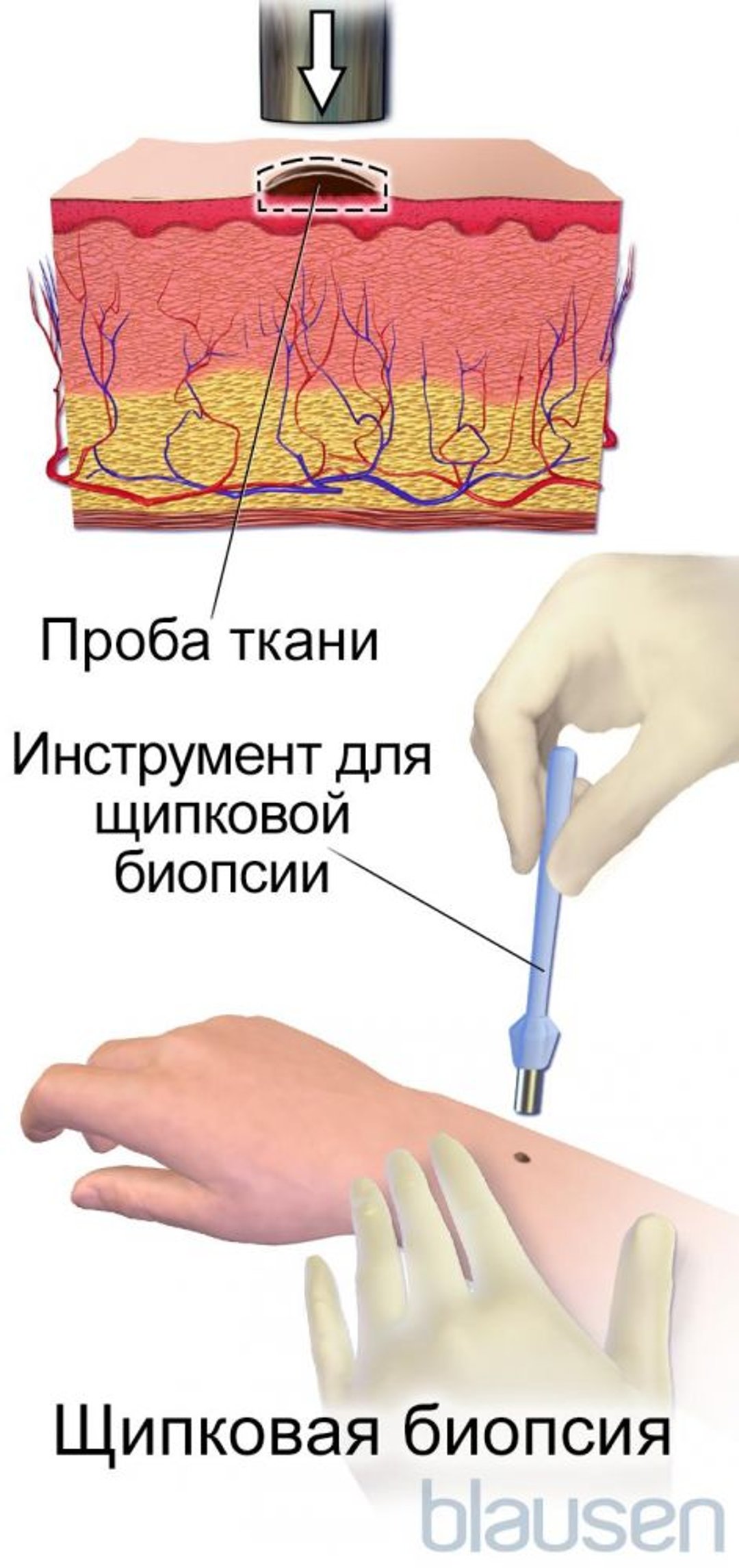 Щипковая биопсия