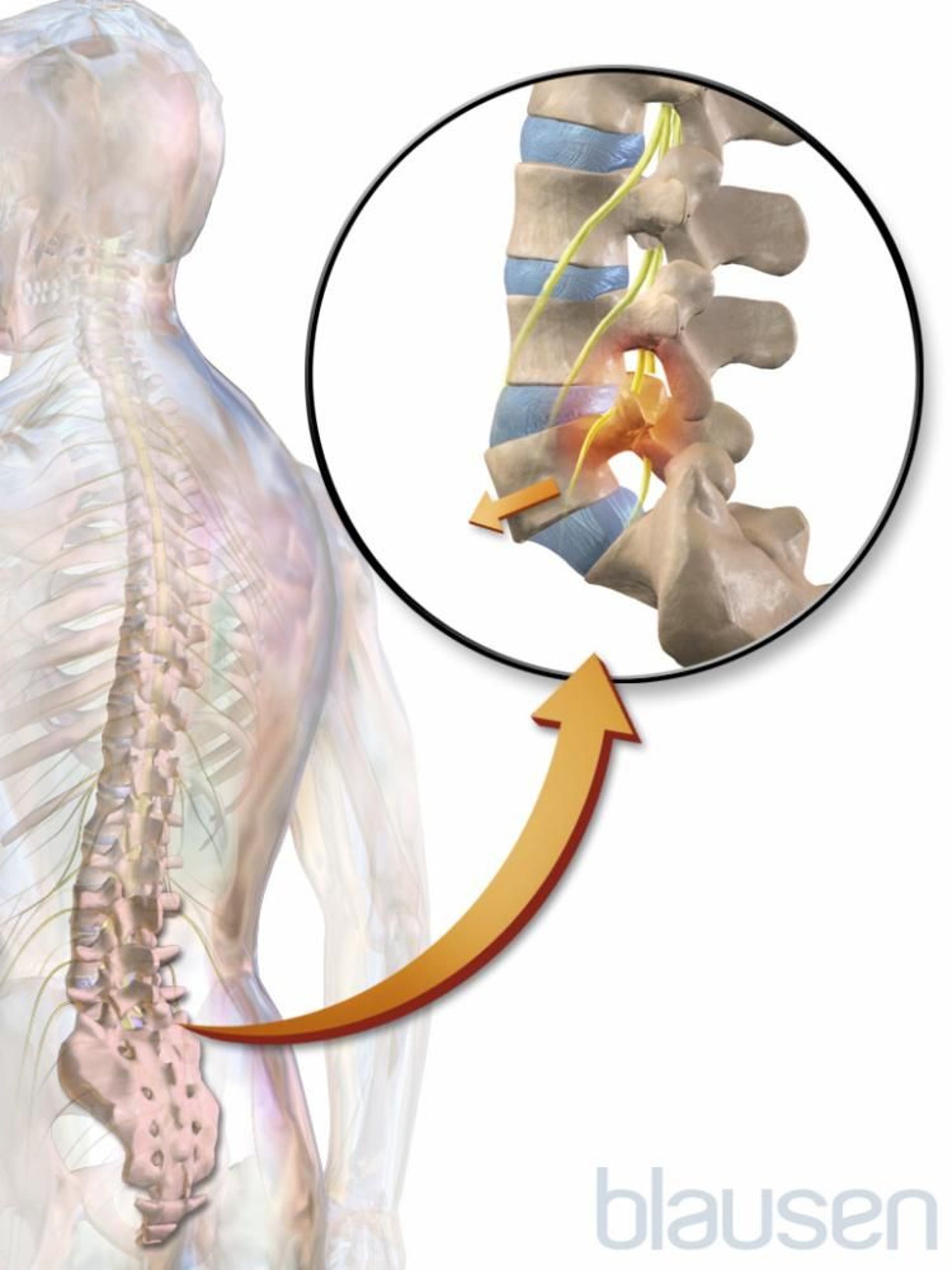 Spondilolistesi