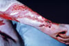 Sporotrichosis Kali