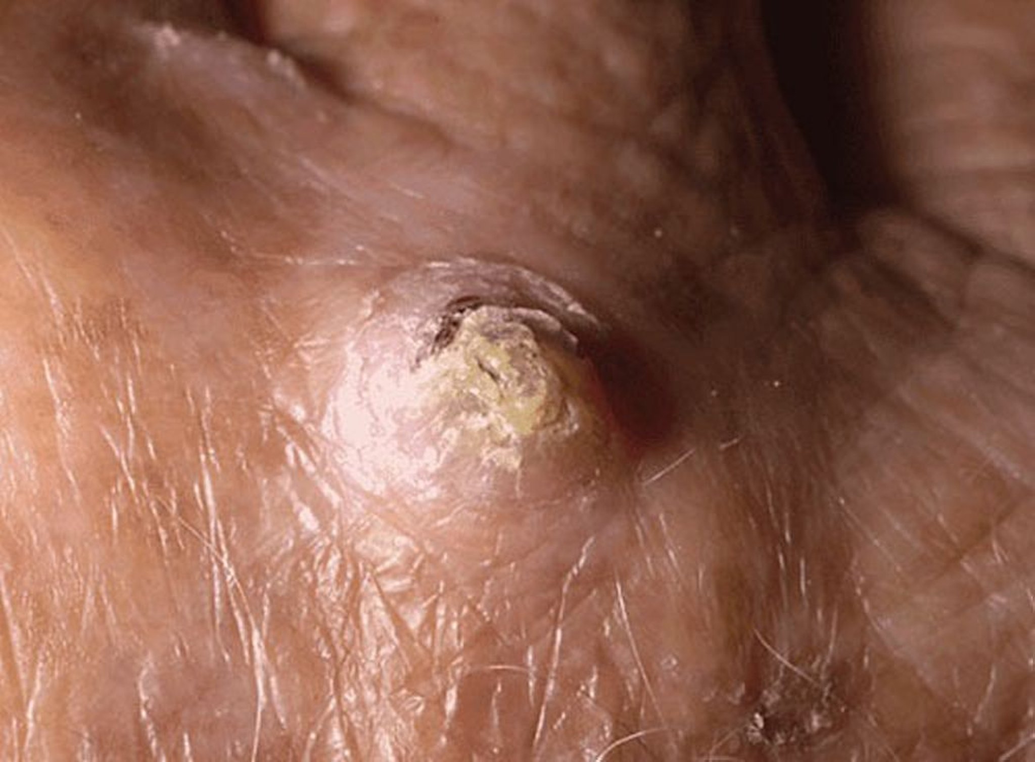 Carcinoma a cellule squamose
