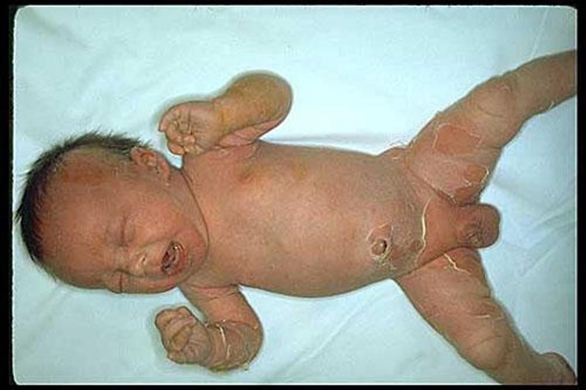 Sindrome stafilococcica della cute ustionata (neonato)